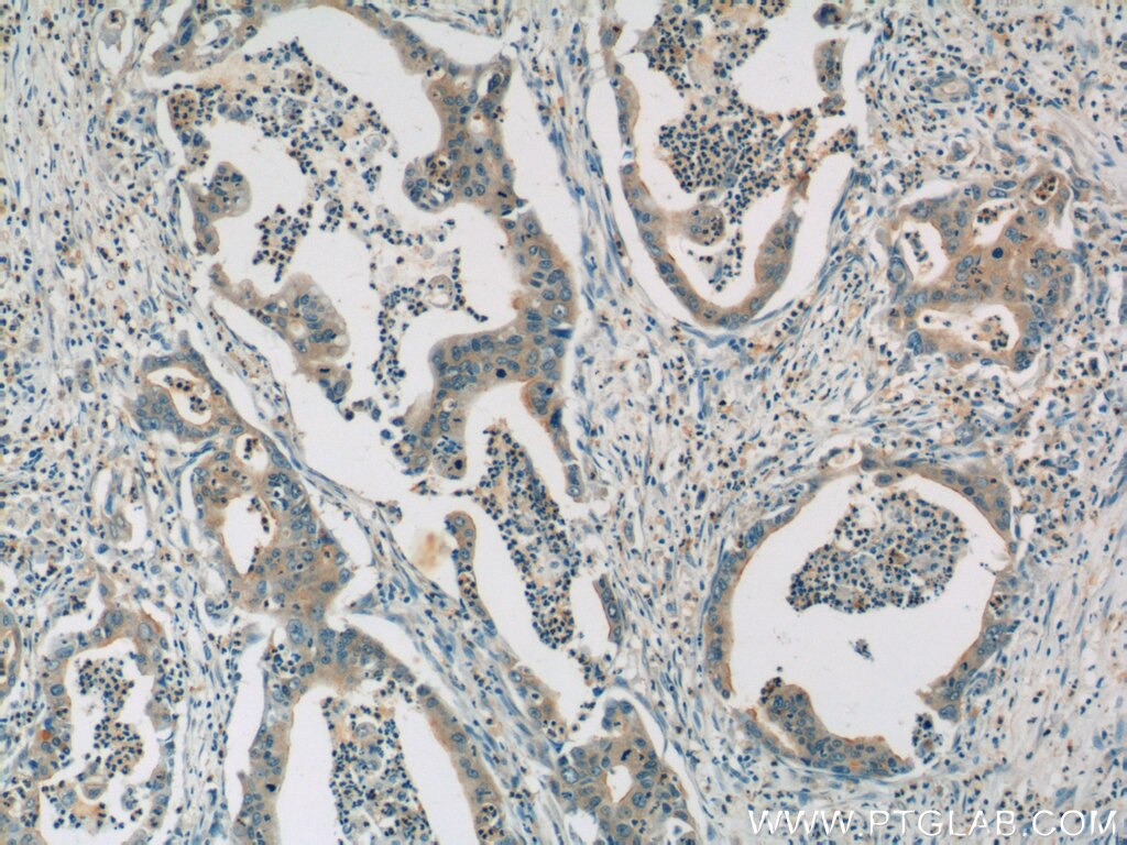 Immunohistochemistry (IHC) staining of human pancreas cancer tissue using HSPH1 Polyclonal antibody (13383-1-AP)