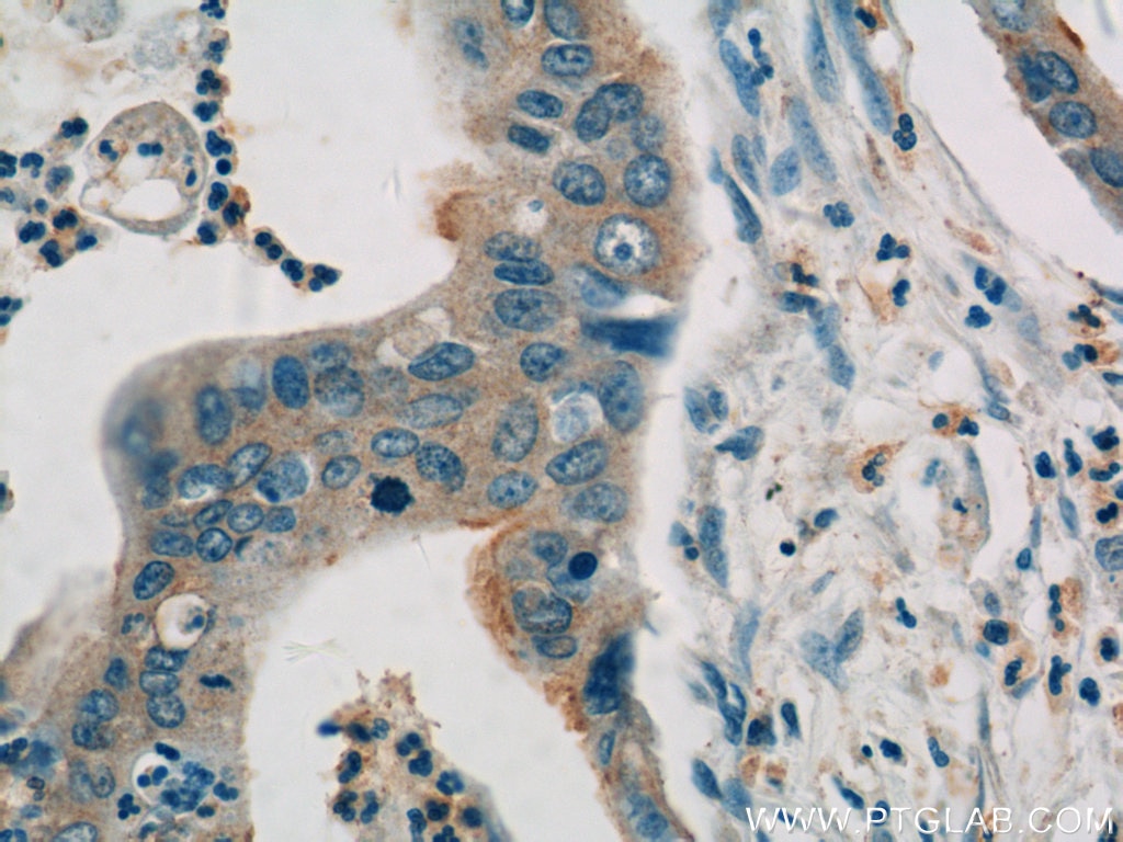 IHC staining of human pancreas cancer using 13383-1-AP