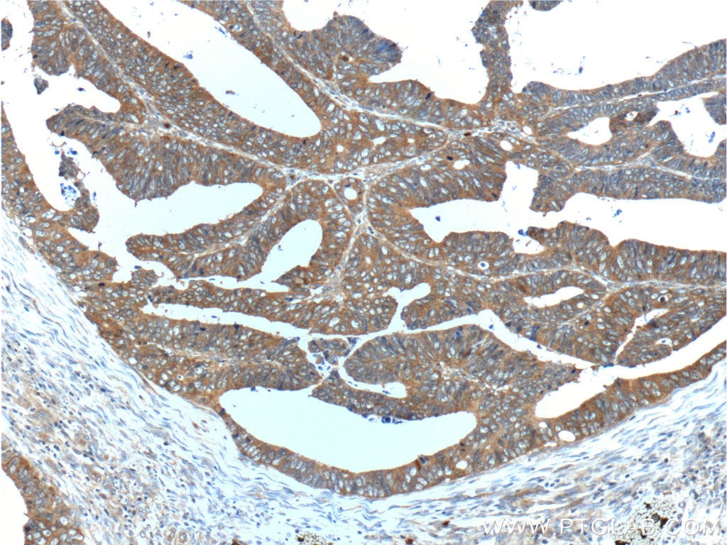 Immunohistochemistry (IHC) staining of human colon cancer tissue using HSPH1 Polyclonal antibody (13383-1-AP)