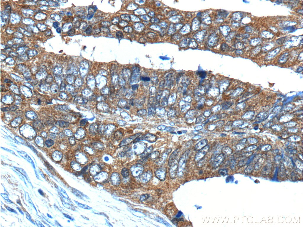 Immunohistochemistry (IHC) staining of human colon cancer tissue using HSPH1 Polyclonal antibody (13383-1-AP)