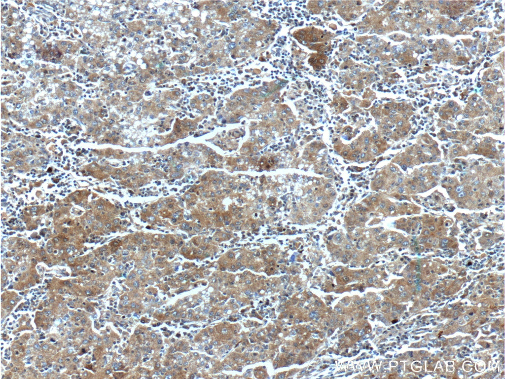 IHC staining of human liver cancer using 13383-1-AP