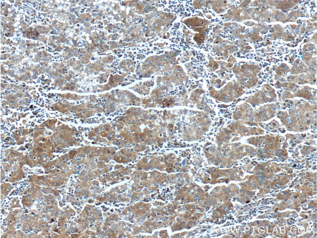 Immunohistochemistry (IHC) staining of human liver cancer tissue using HSPH1 Polyclonal antibody (13383-1-AP)