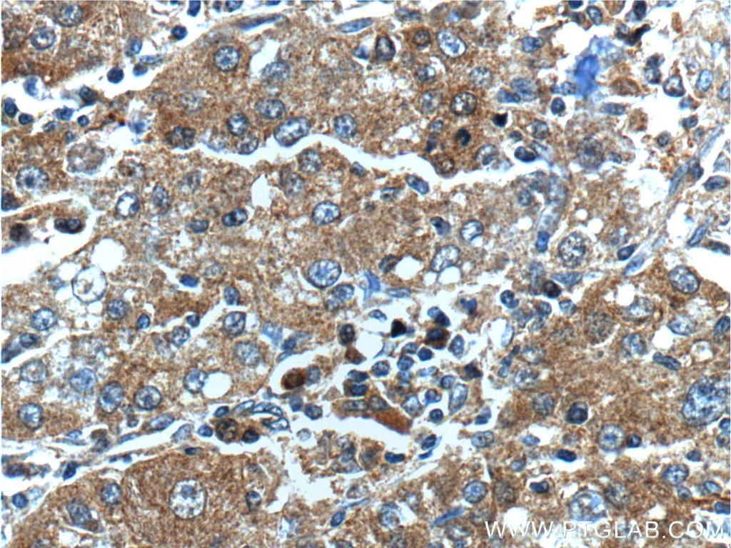 Immunohistochemistry (IHC) staining of human liver cancer tissue using HSPH1 Polyclonal antibody (13383-1-AP)