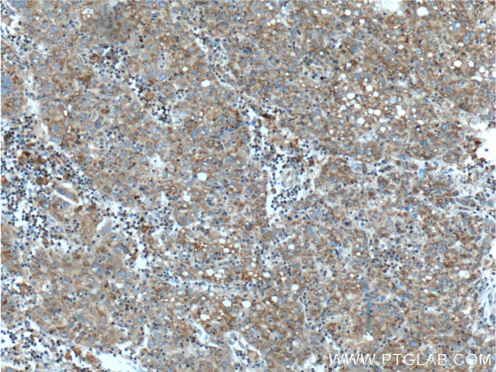 Immunohistochemistry (IHC) staining of human liver cancer tissue using TIP30 Polyclonal antibody (10251-1-AP)