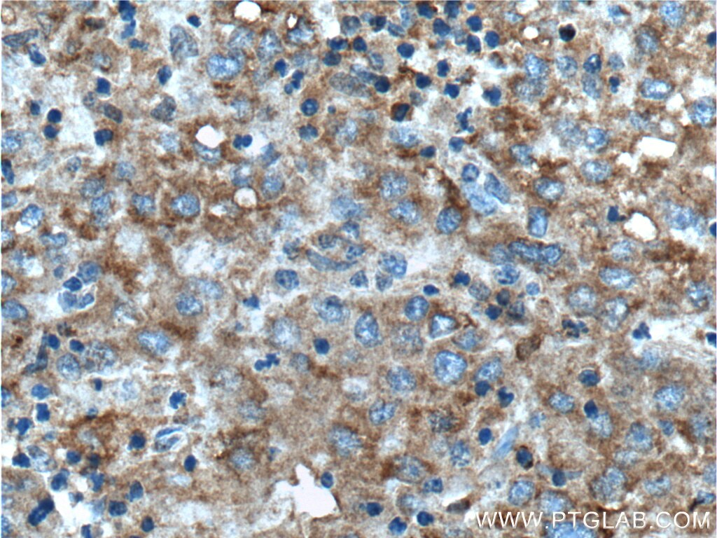 Immunohistochemistry (IHC) staining of human liver cancer tissue using TIP30 Polyclonal antibody (10251-1-AP)