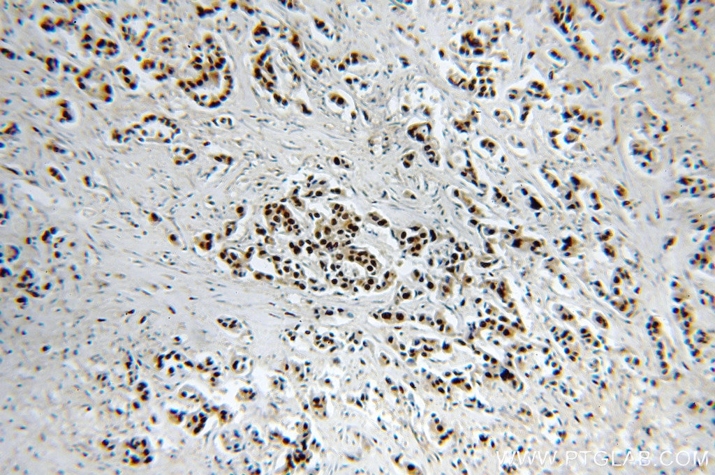 Immunohistochemistry (IHC) staining of human breast cancer tissue using HTATSF1 Polyclonal antibody (20805-1-AP)