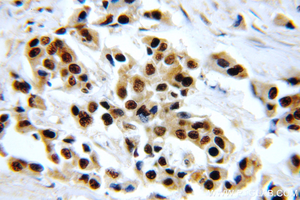 Immunohistochemistry (IHC) staining of human breast cancer tissue using HTATSF1 Polyclonal antibody (20805-1-AP)