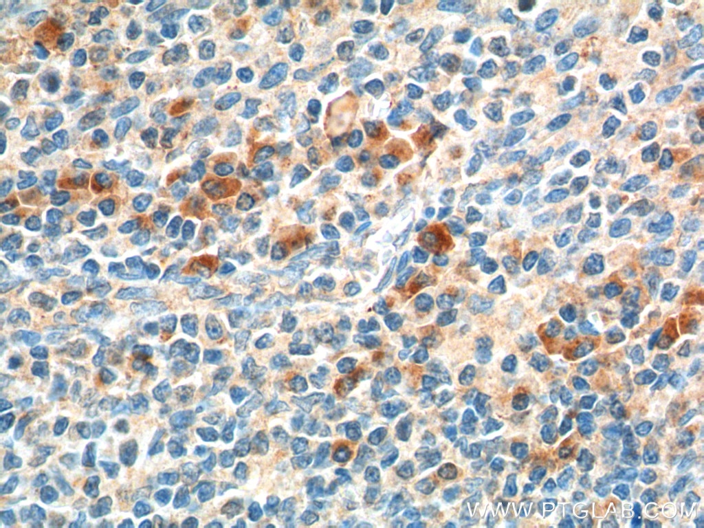 Immunohistochemistry (IHC) staining of human tonsillitis tissue using HTR1A Polyclonal antibody (55302-1-AP)