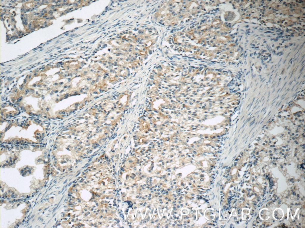 Immunohistochemistry (IHC) staining of human prostate cancer tissue using HTR3A Polyclonal antibody (10443-1-AP)