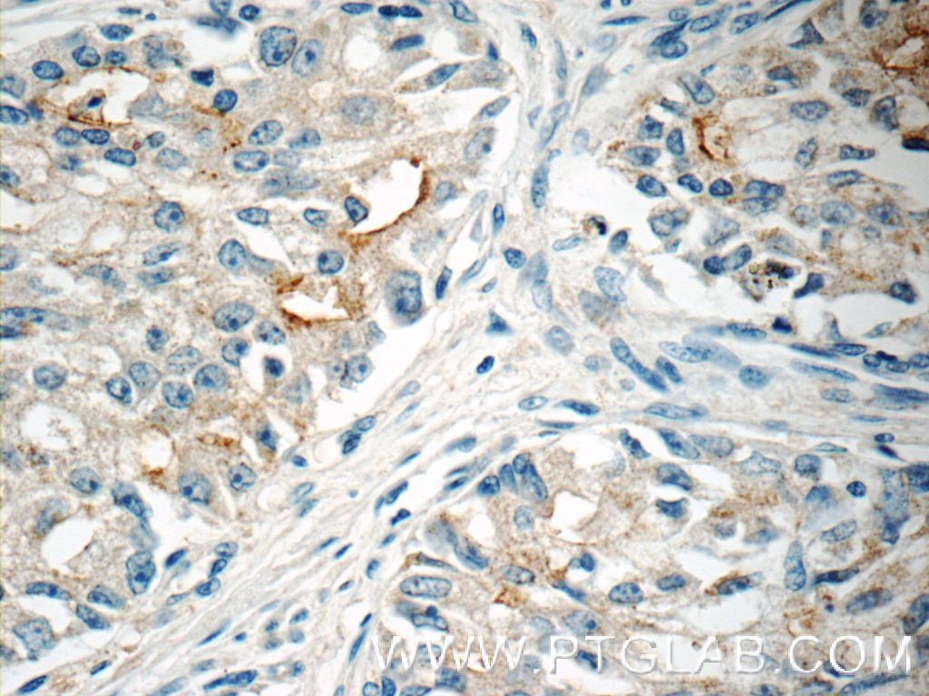 Immunohistochemistry (IHC) staining of human prostate cancer tissue using HTR3A Polyclonal antibody (10443-1-AP)