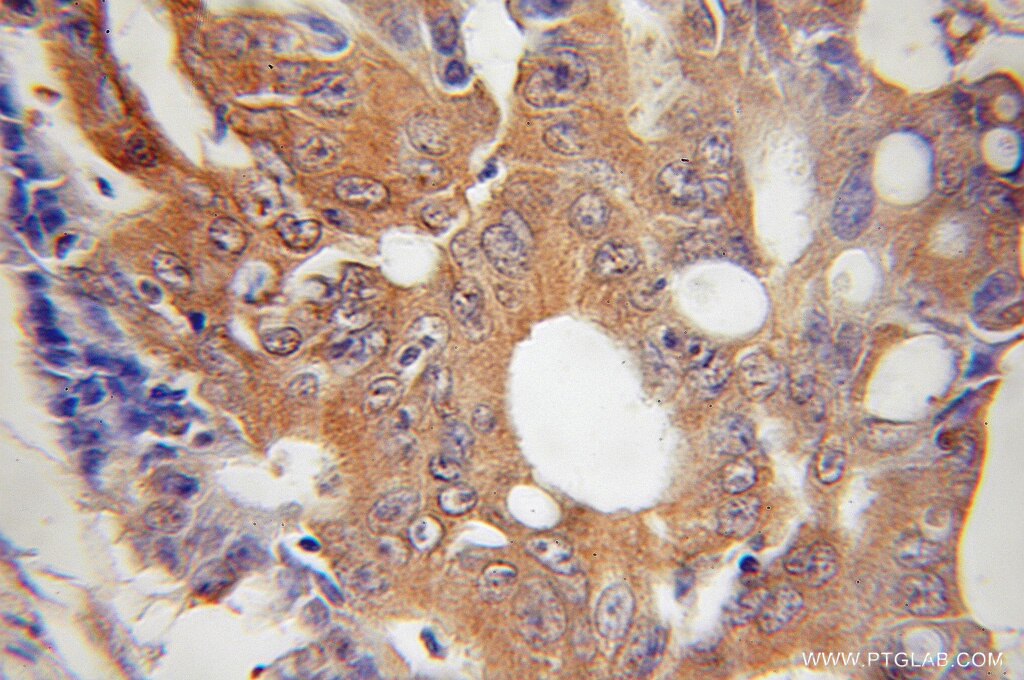 Immunohistochemistry (IHC) staining of human colon cancer tissue using HUS1 Polyclonal antibody (11223-1-AP)