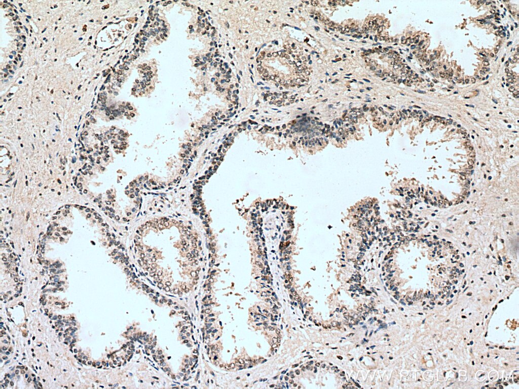 Immunohistochemistry (IHC) staining of human prostate cancer tissue using HUS1 Monoclonal antibody (67168-1-Ig)