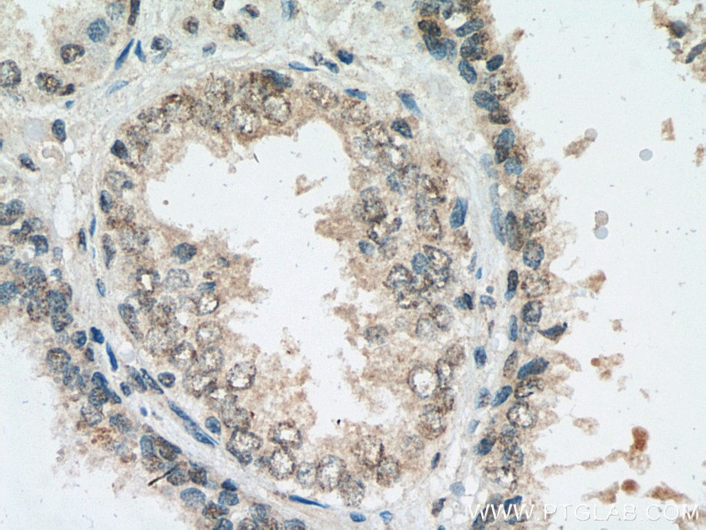 Immunohistochemistry (IHC) staining of human prostate cancer tissue using HUS1 Monoclonal antibody (67168-1-Ig)