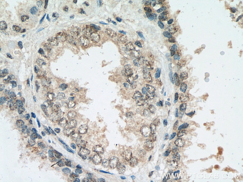 IHC staining of human prostate cancer using 67168-1-Ig