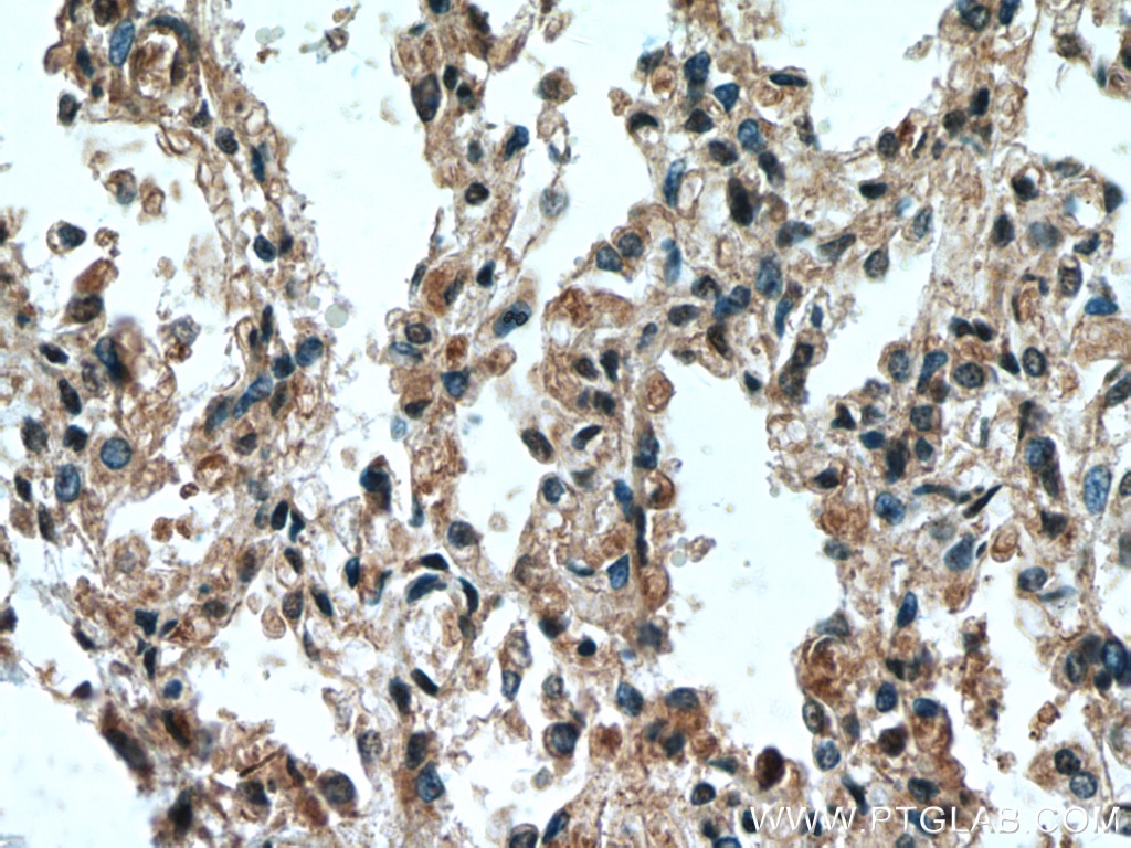 Immunohistochemistry (IHC) staining of human lung tissue using HUWE1 Polyclonal antibody (19430-1-AP)