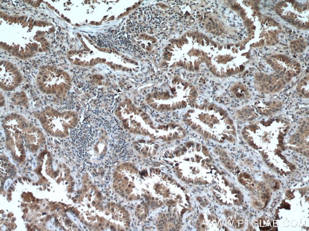 Immunohistochemistry (IHC) staining of human lung cancer tissue using HUWE1 Polyclonal antibody (19430-1-AP)