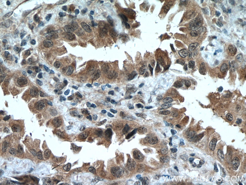 Immunohistochemistry (IHC) staining of human lung cancer tissue using HUWE1 Polyclonal antibody (19430-1-AP)