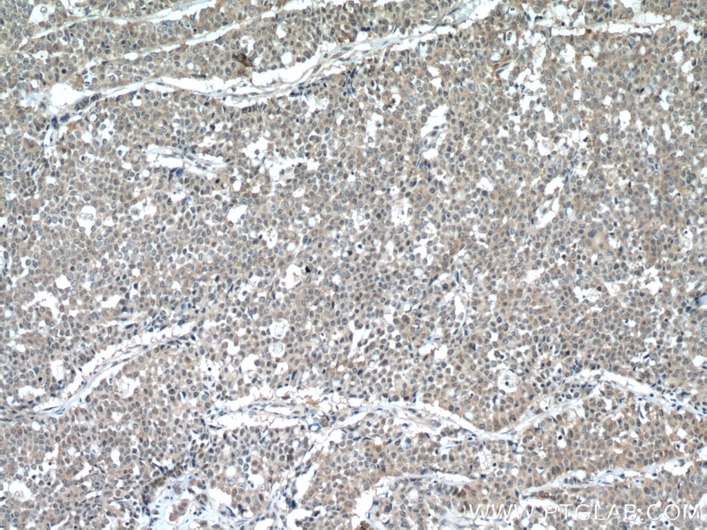 Immunohistochemistry (IHC) staining of human colon cancer tissue using HUWE1 Polyclonal antibody (19430-1-AP)