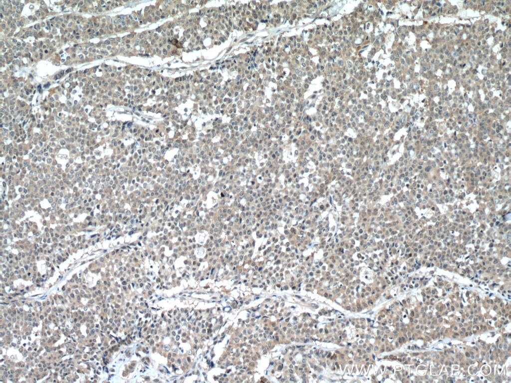 IHC staining of human colon cancer using 19430-1-AP