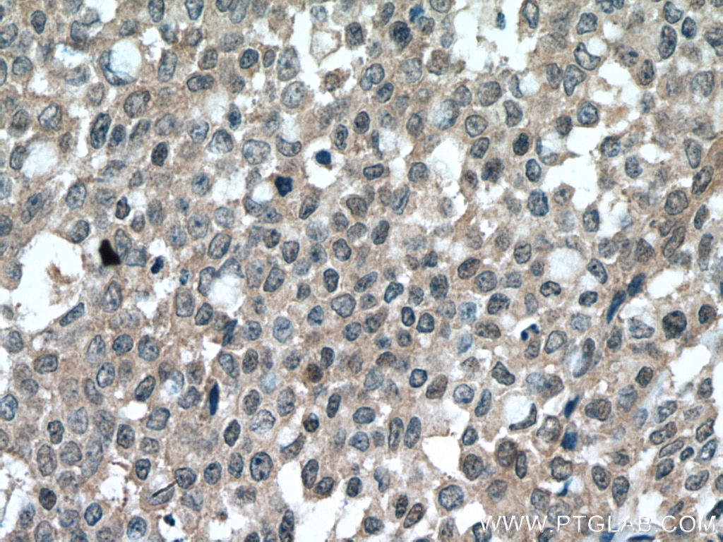 Immunohistochemistry (IHC) staining of human colon cancer tissue using HUWE1 Polyclonal antibody (19430-1-AP)