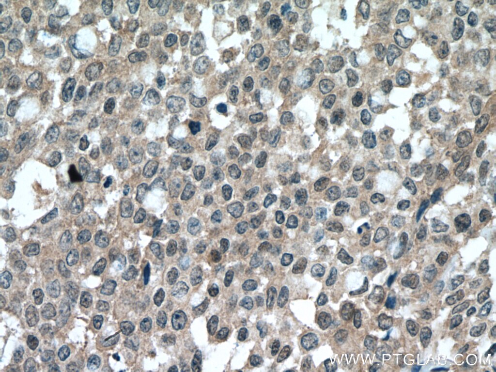 IHC staining of human colon cancer using 19430-1-AP