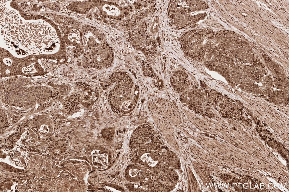 Immunohistochemistry (IHC) staining of human stomach cancer tissue using HUWE1 Polyclonal antibody (19430-1-AP)