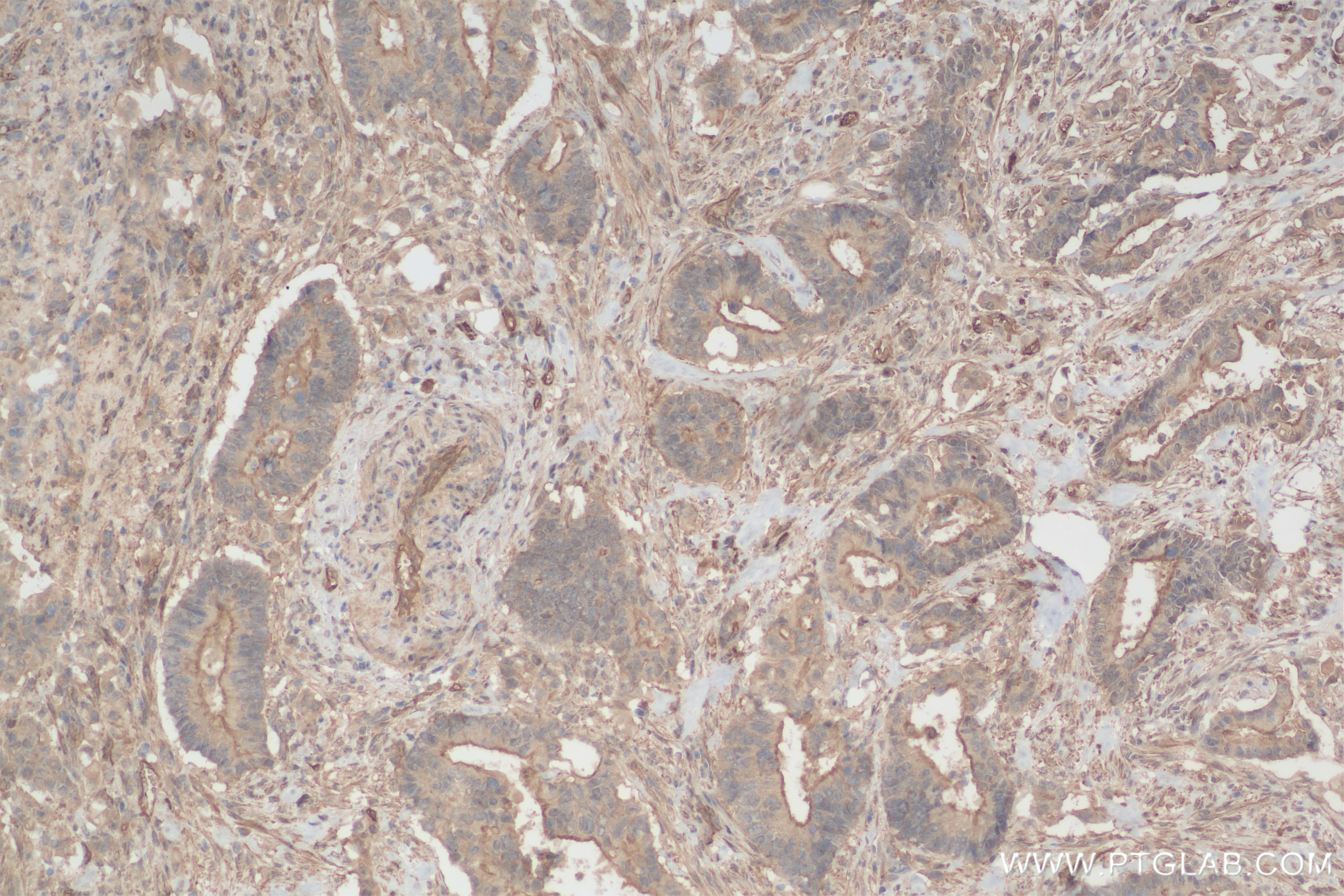 Immunohistochemistry (IHC) staining of human rectal cancer tissue using HUWE1 Recombinant antibody (85177-3-RR)