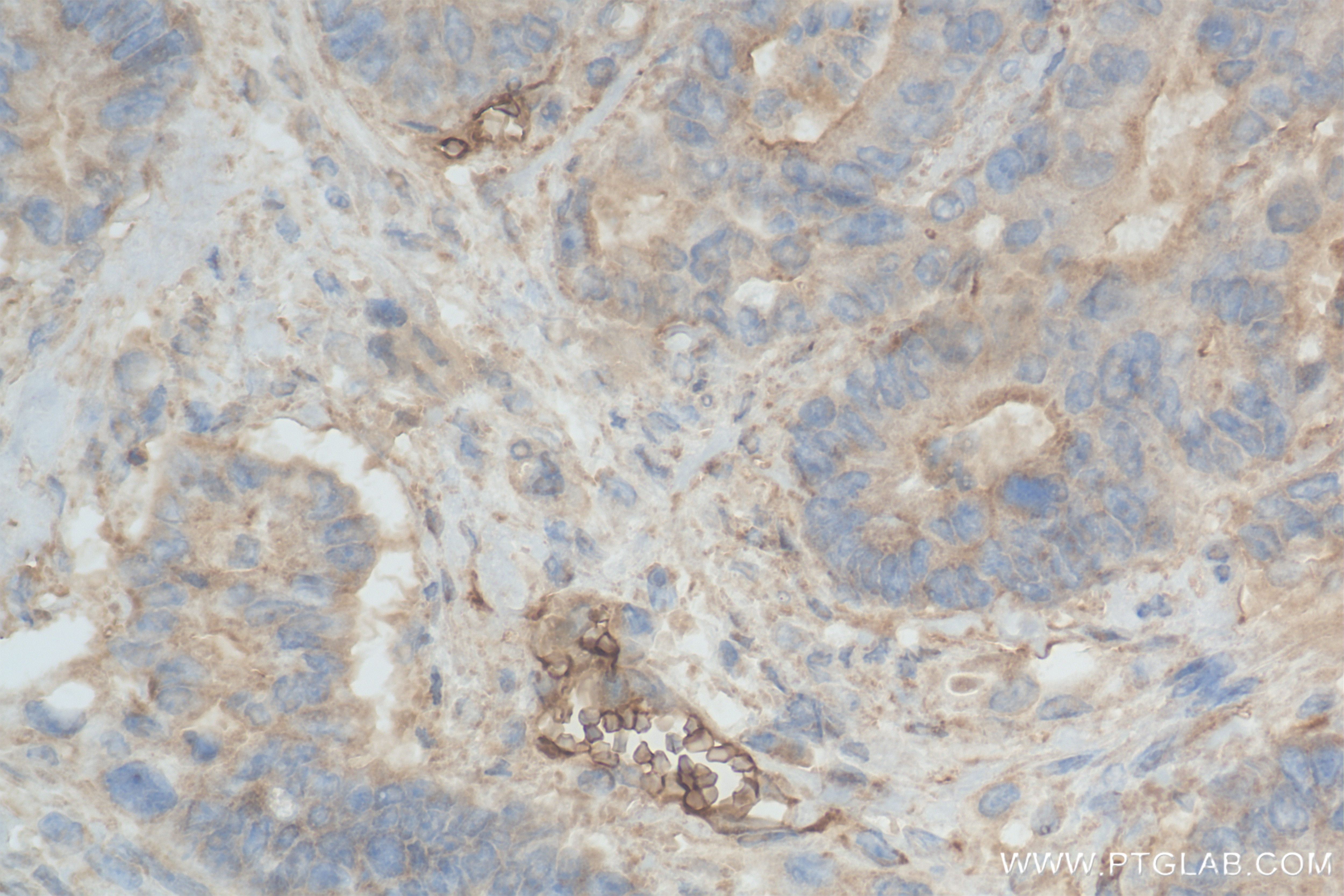Immunohistochemistry (IHC) staining of human rectal cancer tissue using HUWE1 Recombinant antibody (85177-3-RR)