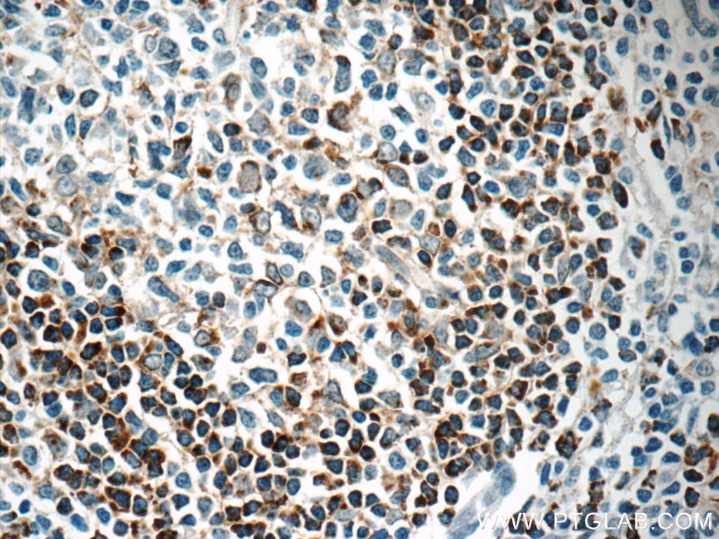 Immunohistochemistry (IHC) staining of human tonsillitis tissue using HVCN1 Polyclonal antibody (14162-1-AP)