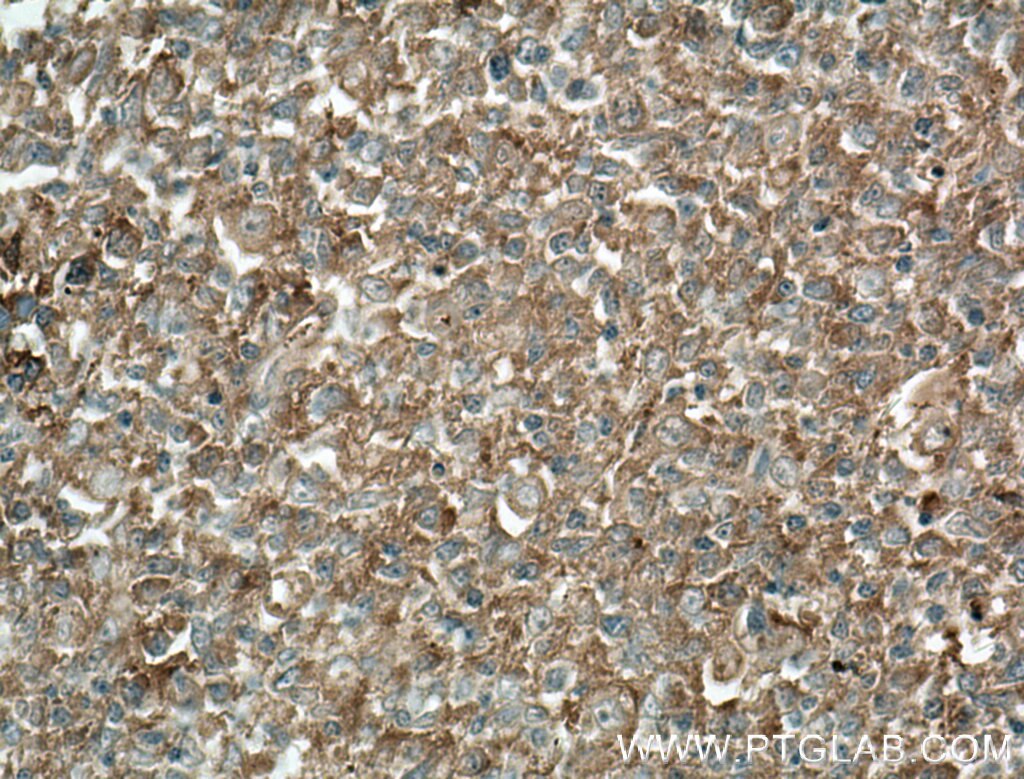 IHC staining of human tonsillitis using 66449-1-Ig