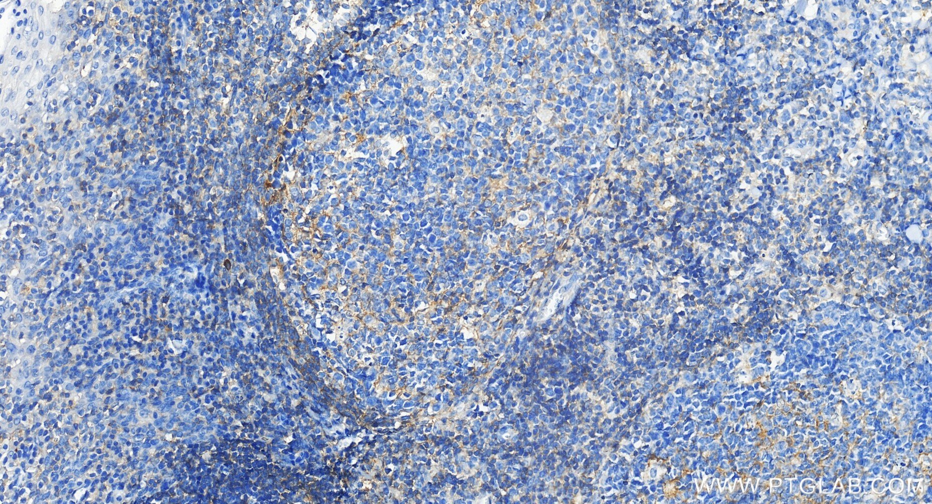 Immunohistochemical analysis of paraffin-embedded human tonsillitis tissue slide using 81078-6-RR (HVEM/TNFRSF14 antibody) at dilution of 1:2000 (under 20x lens). Heat mediated antigen retrieval with Tris-EDTA buffer (pH 9.0). Immunohistochemistry (IHC) staining of human tonsillitis tissue using HVEM/TNFRSF14 Recombinant monoclonal antibody (81078-6-RR)