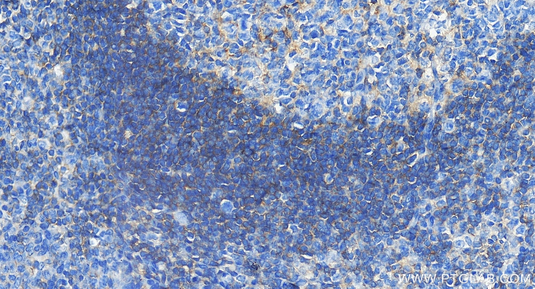 Immunohistochemical analysis of paraffin-embedded human tonsillitis tissue slide using 81078-6-RR (HVEM/TNFRSF14 antibody) at dilution of 1:2000 (under 40x lens). Heat mediated antigen retrieval with Tris-EDTA buffer (pH 9.0). Immunohistochemistry (IHC) staining of human tonsillitis tissue using HVEM/TNFRSF14 Recombinant monoclonal antibody (81078-6-RR)
