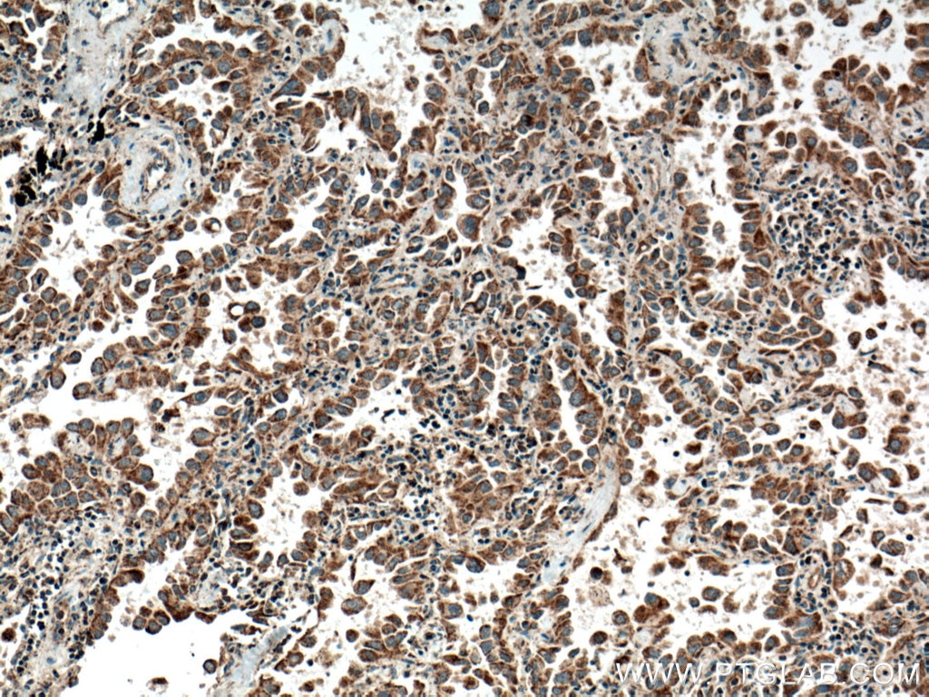 Immunohistochemistry (IHC) staining of human lung cancer tissue using HYAL2 Polyclonal antibody (15115-1-AP)