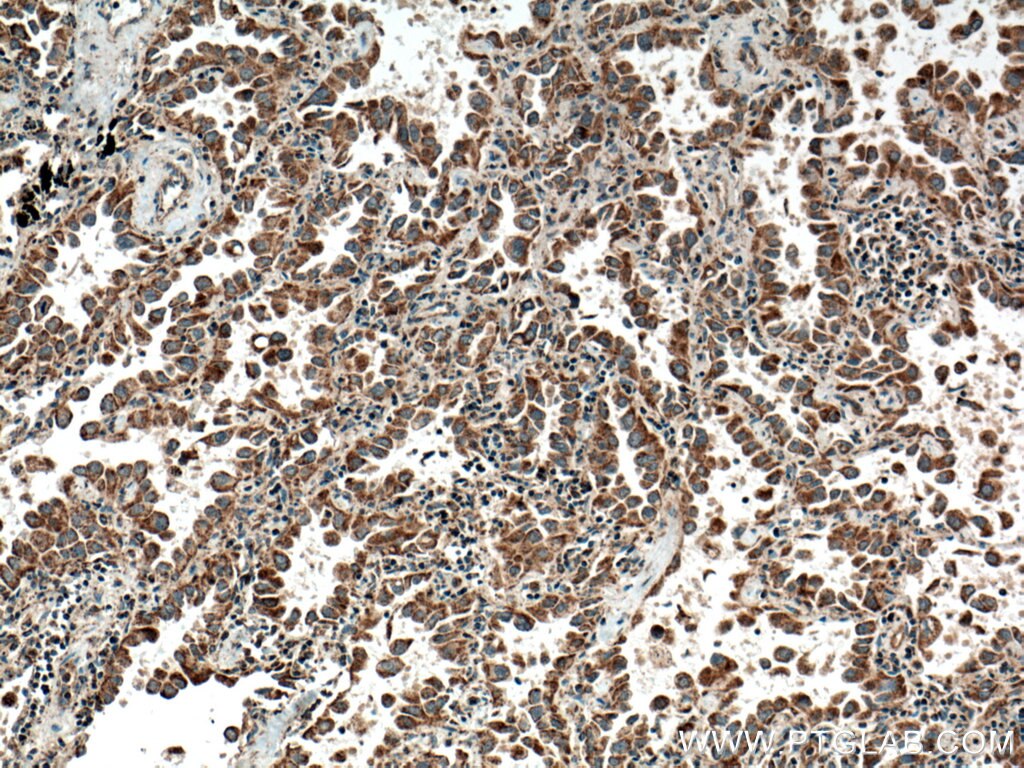 Immunohistochemistry (IHC) staining of human lung cancer tissue using HYAL2 Polyclonal antibody (15115-1-AP)