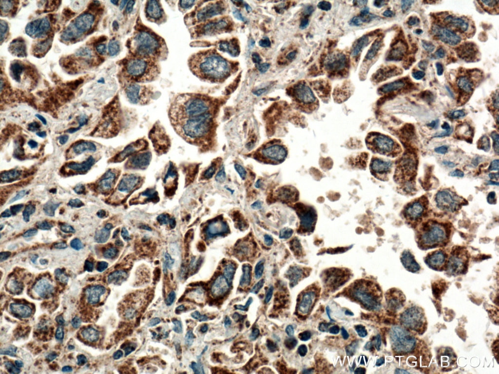 Immunohistochemistry (IHC) staining of human lung cancer tissue using HYAL2 Polyclonal antibody (15115-1-AP)