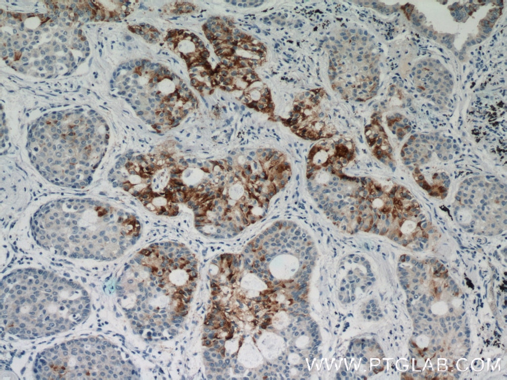 Immunohistochemistry (IHC) staining of human lung cancer tissue using HYAL2 Polyclonal antibody (51148-1-AP)
