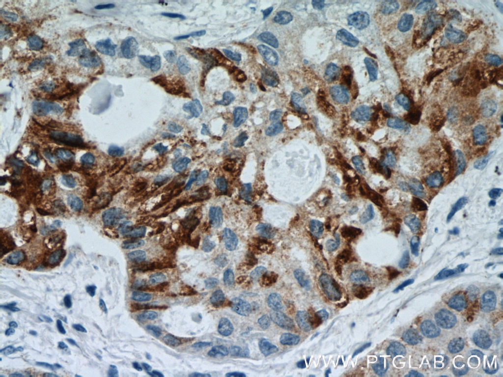 Immunohistochemistry (IHC) staining of human lung cancer tissue using HYAL2 Polyclonal antibody (51148-1-AP)