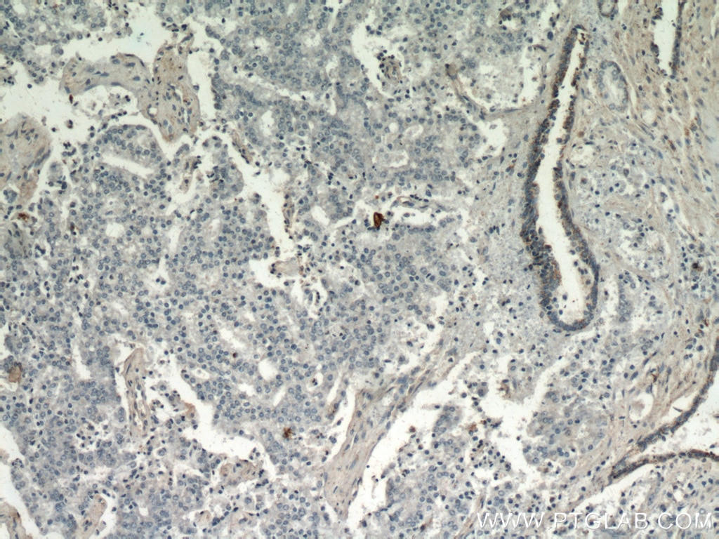 Immunohistochemistry (IHC) staining of human prostate cancer tissue using HYAL3 Polyclonal antibody (19625-1-AP)