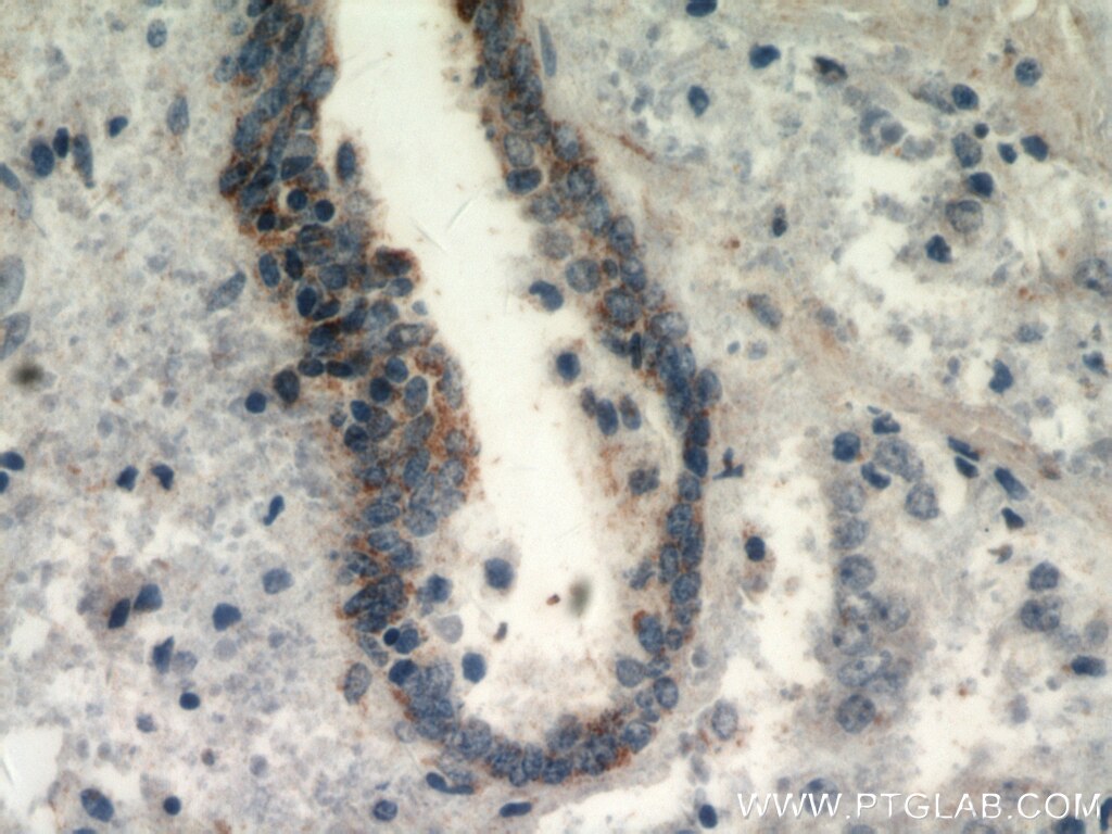 Immunohistochemistry (IHC) staining of human prostate cancer tissue using HYAL3 Polyclonal antibody (19625-1-AP)