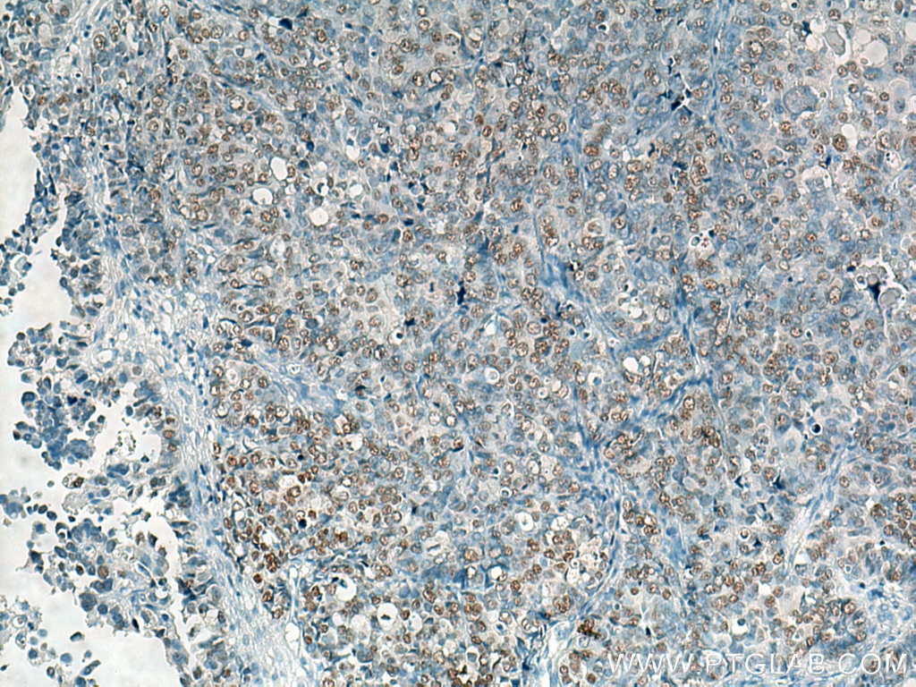 IHC staining of human ovary tumor using Biotin-66467