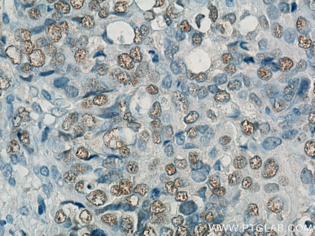 Immunohistochemistry (IHC) staining of human ovary tumor tissue using Biotin-conjugated Heavy chain of Rabbit IgG Monocl (Biotin-66467)
