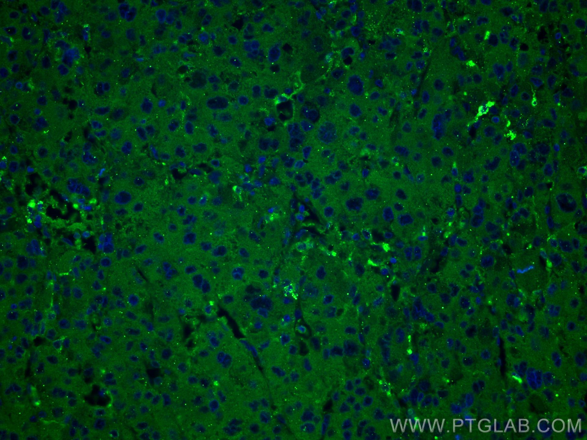 Immunofluorescence (IF) / fluorescent staining of human liver cancer tissue using Hemopexin Monoclonal antibody (66479-1-Ig)