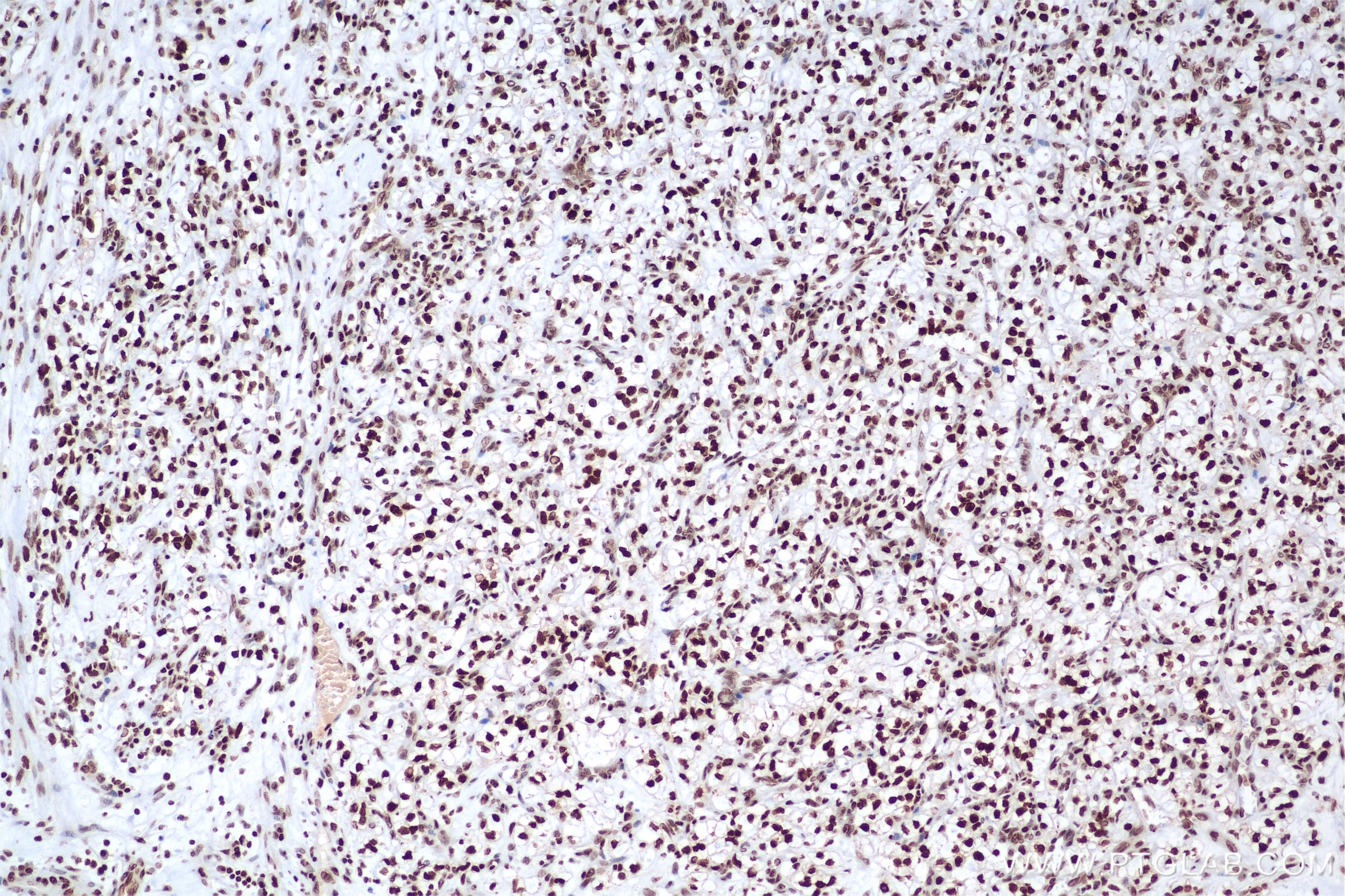Immunohistochemistry (IHC) staining of human kidney(renal cell) Cancer using Histone H2A.X Recombinant antibody (83307-3-RR)