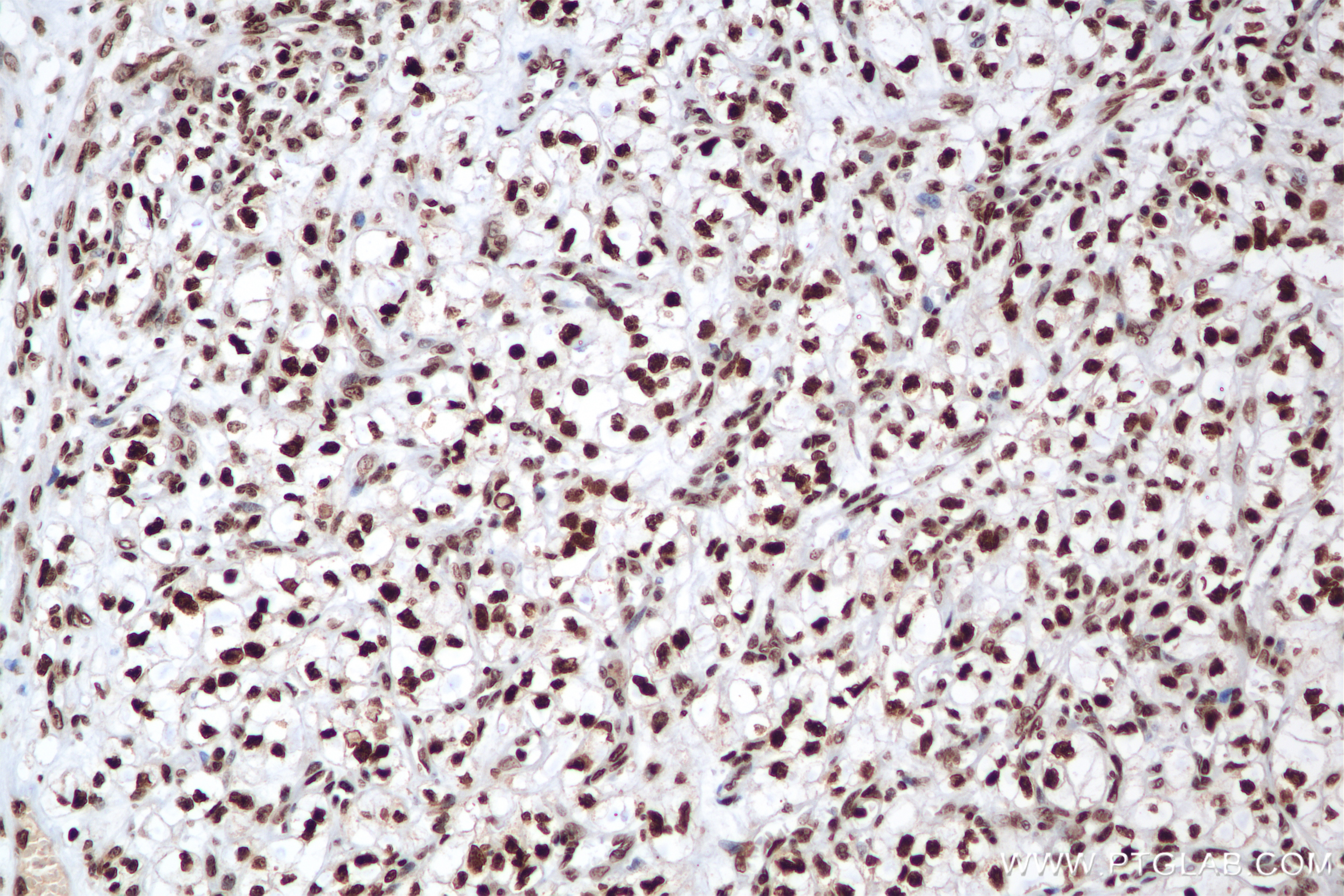 Immunohistochemistry (IHC) staining of human kidney(renal cell) Cancer using Histone H2A.X Recombinant antibody (83307-3-RR)