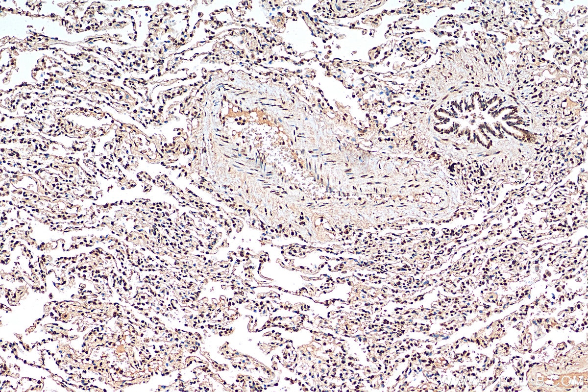 Immunohistochemistry (IHC) staining of human lung cancer tissue using Histone H2B Monoclonal antibody (68393-1-Ig)