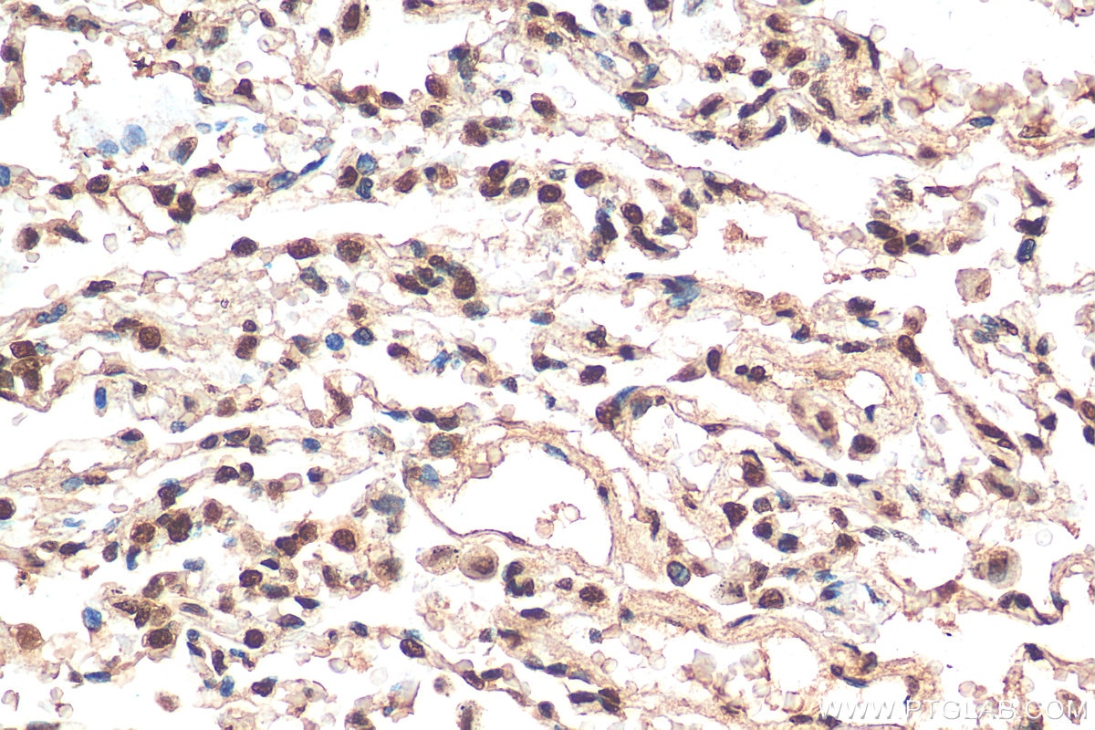 Immunohistochemistry (IHC) staining of human lung cancer tissue using Histone H2B Monoclonal antibody (68393-1-Ig)