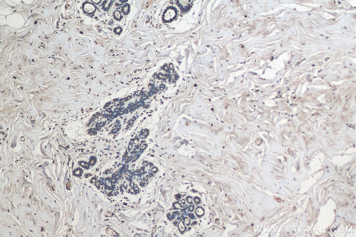 IHC staining of human breast cancer using 17168-1-AP