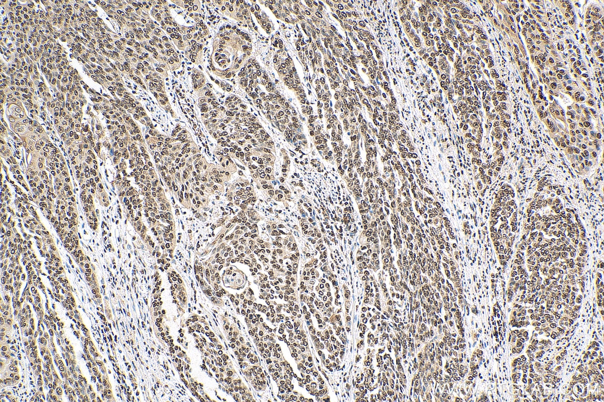 Immunohistochemistry (IHC) staining of human oesophagus cancer tissue using Histone-H3 Polyclonal antibody (17168-1-AP)