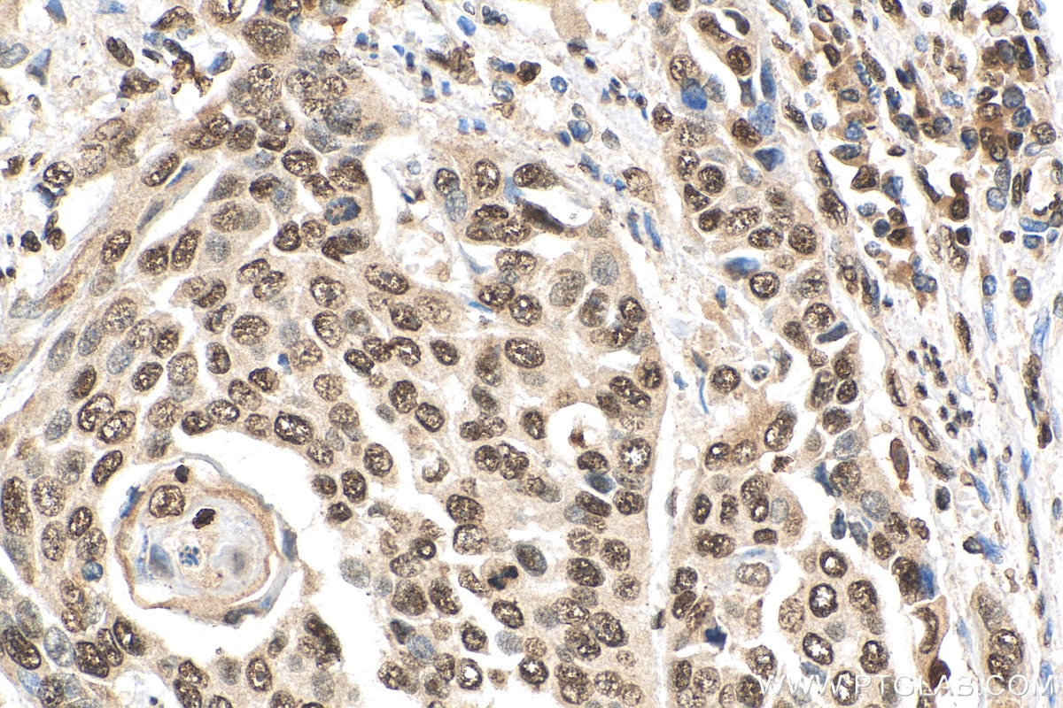 Immunohistochemistry (IHC) staining of human oesophagus cancer tissue using Histone-H3 Polyclonal antibody (17168-1-AP)