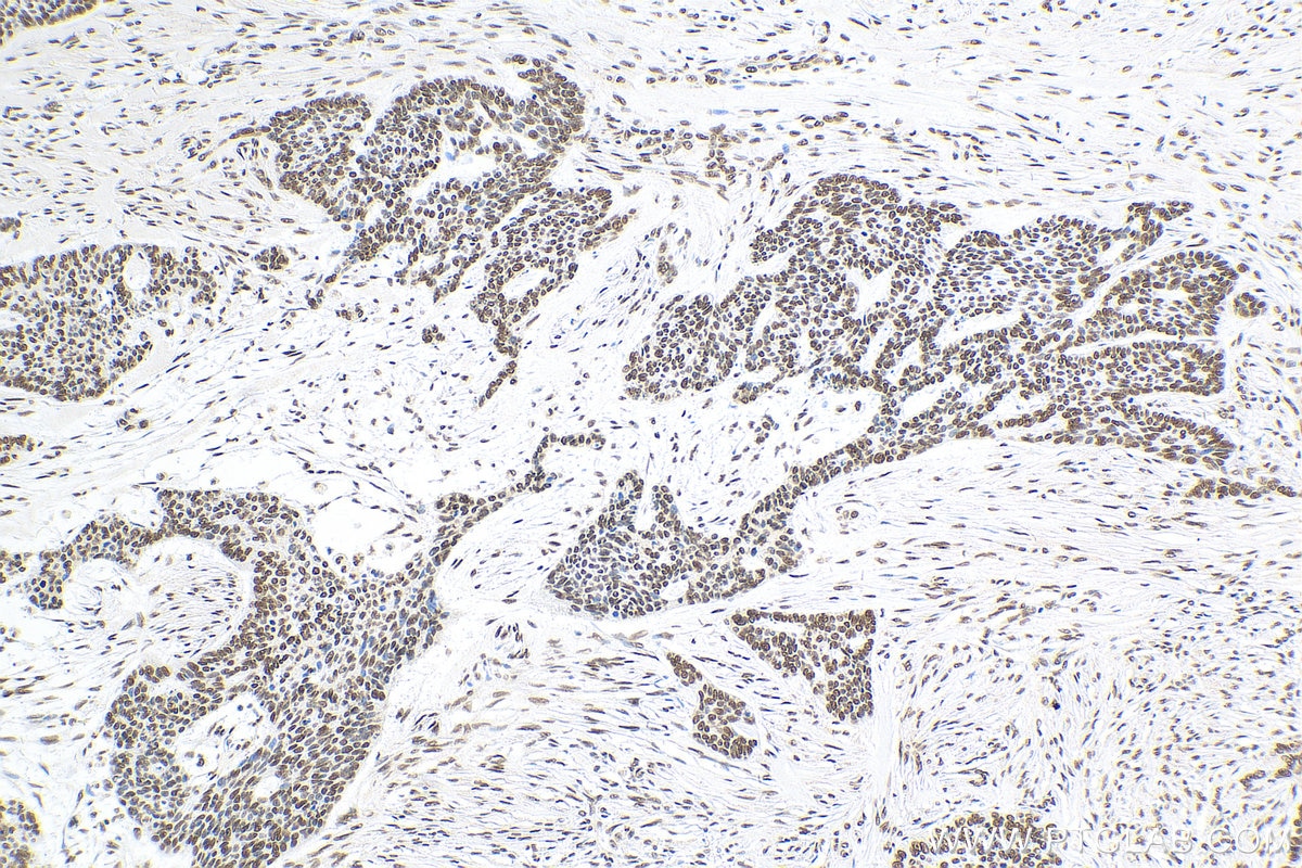 Immunohistochemistry (IHC) staining of human skin cancer tissue using Histone-H3 Polyclonal antibody (17168-1-AP)